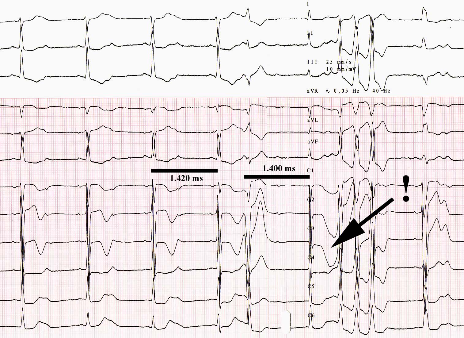 Dr franck Halimi, Torsade de pointes